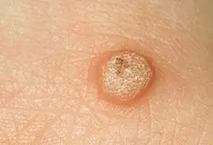 warts1