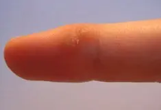 warts