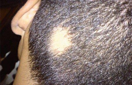 alopecia {{brizy_dc_image_alt entityId=