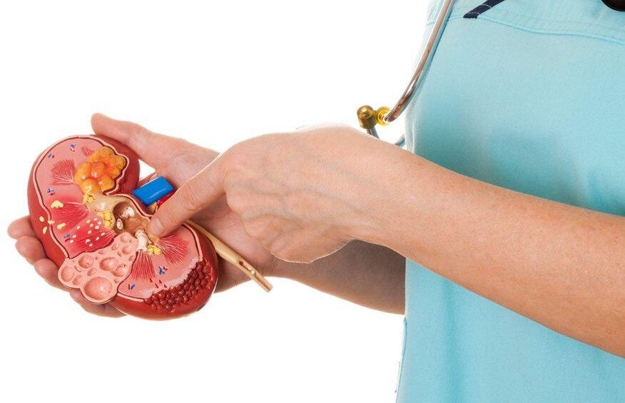 kidney-stone {{brizy_dc_image_alt entityId=